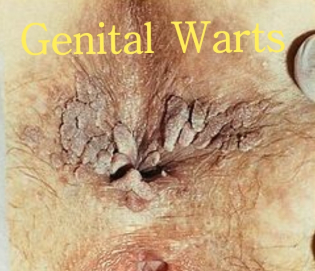 Genital Warts